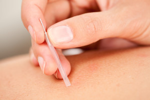 chiropractic treatment dry needling